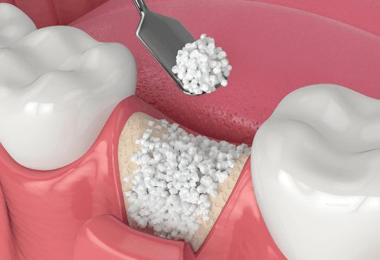 What Is Bone Grafting?