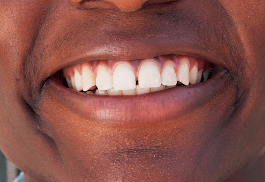 What Are Composite Fillings?