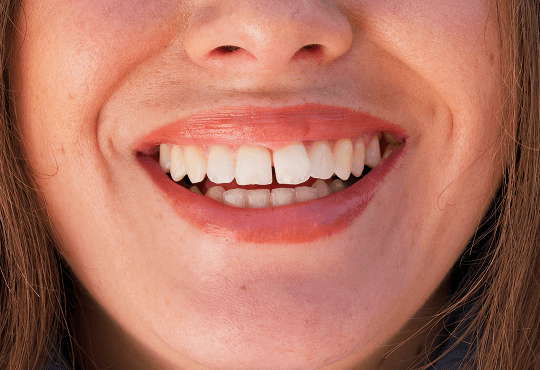 What Is Dental Bonding?