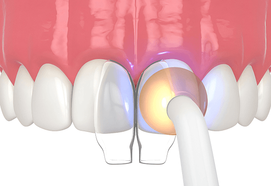 What Dental Bonding Can Fix