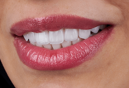Why Patients Love Dental Bonding at Kempsville Dental