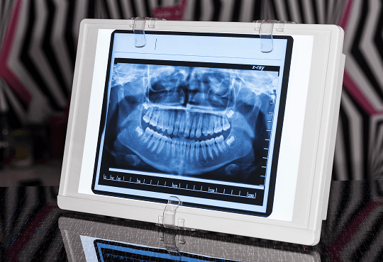 Why We Use Digital Radiographs