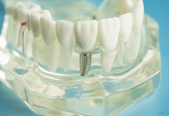 Why Choose Mini Dental Implants?