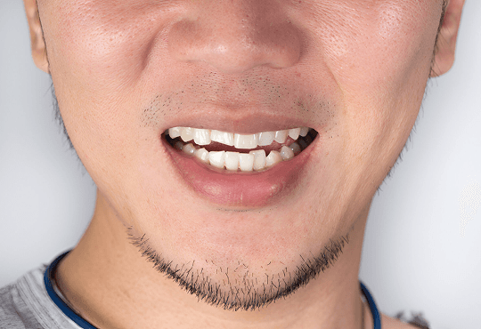 What Are Porcelain Crowns (Caps)?