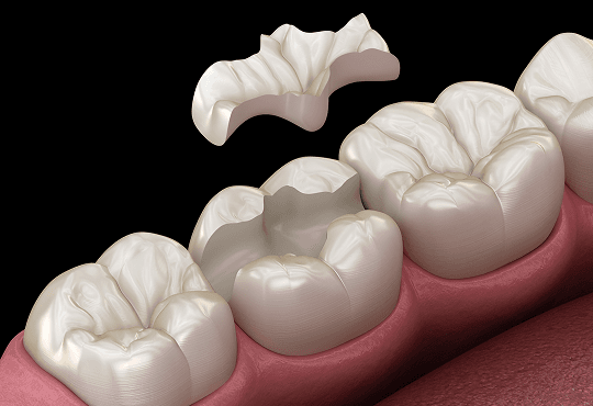 What Are Porcelain Inlays?