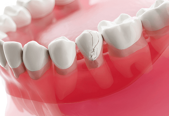 What Are Porcelain Veneers?