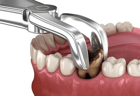 When Is a Tooth Extraction Needed?