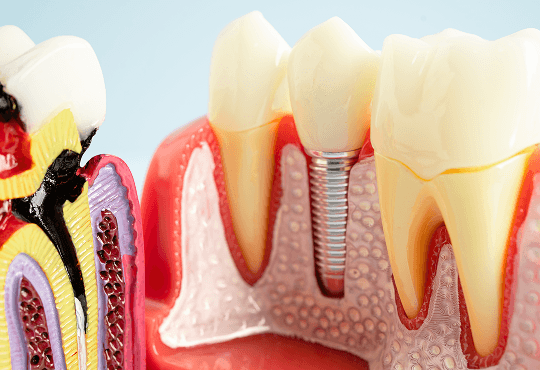 Benefits of Dental Implants