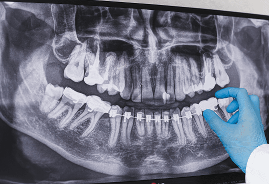 What Are Panoramic X-Rays & How They Work