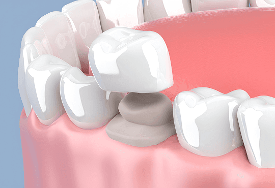 What Are Procera Crowns?
