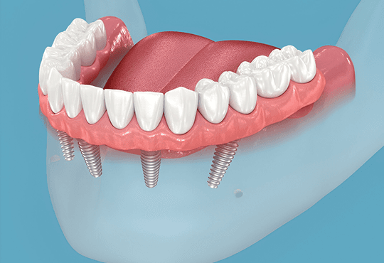 What Is a Prosthodontist?