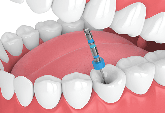 Benefits of Root Canal Therapy