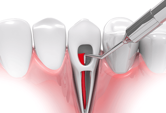 Signs and Symptoms for Possible Root Canal Therapy