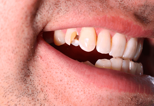 What Happens During Root Canal Retreatment?