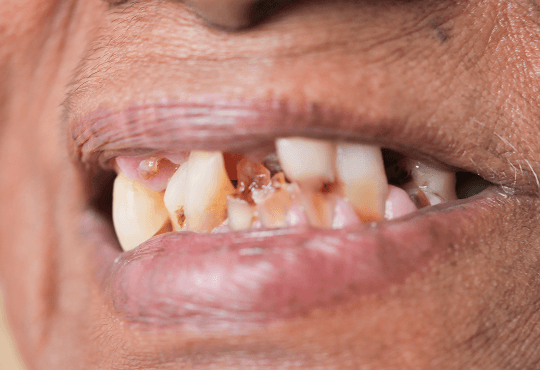 What Are Dental Restorations?