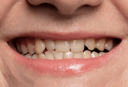 What Is a Simple Tooth Extraction?