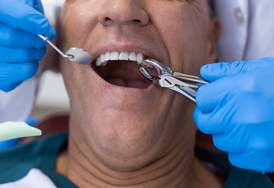 Why a Tooth Might Need to Be Removed