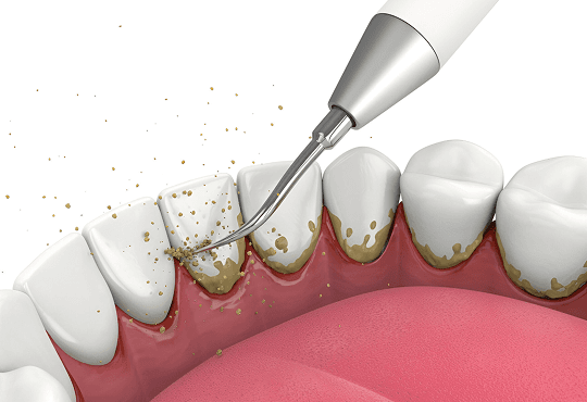 What Is Periodontal (Gum) Disease?
