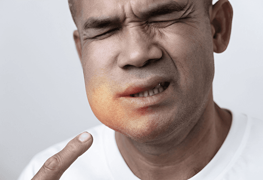 What Are Wisdom Teeth?