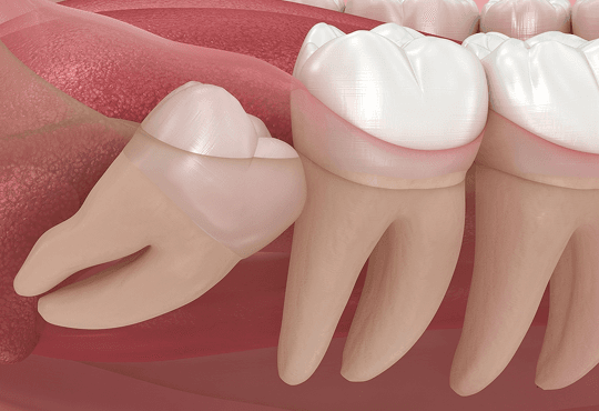 Why Wisdom Teeth May Need Removal