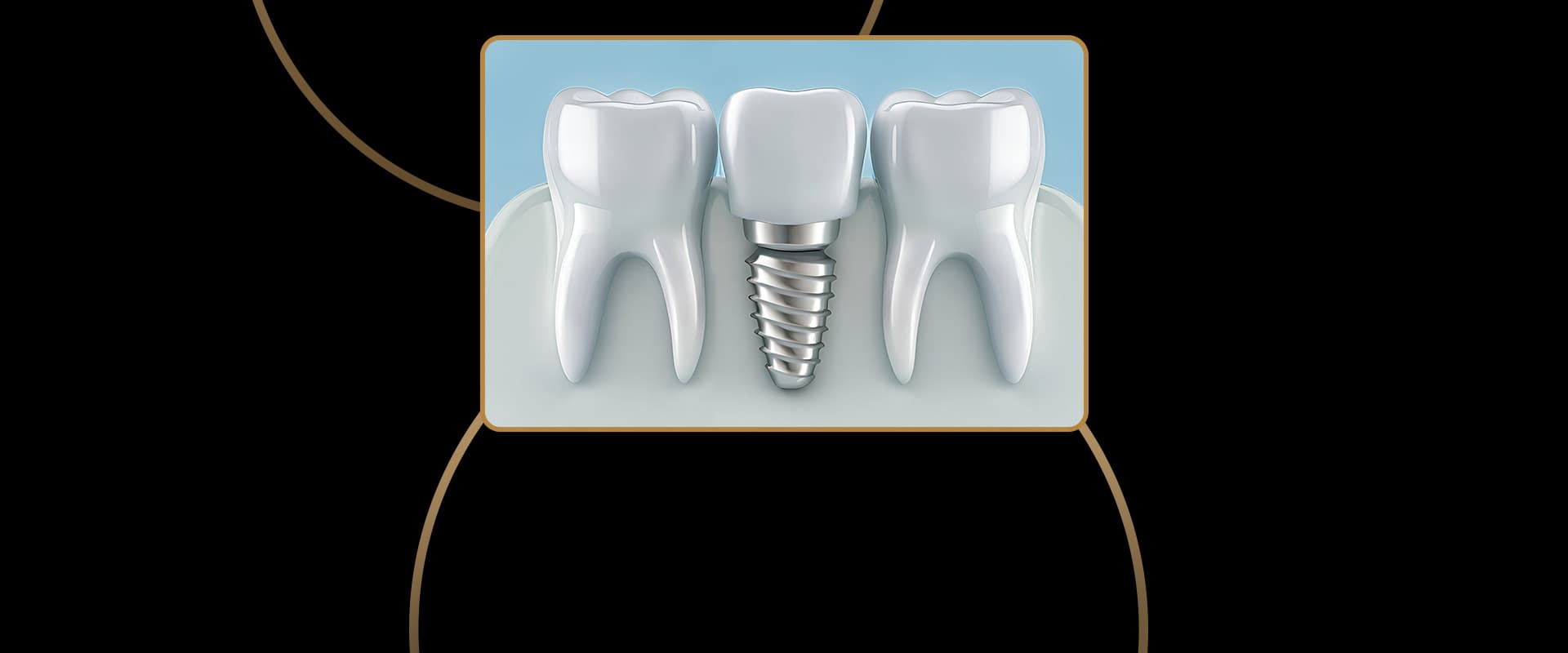 Dental Implants Cosmetic
