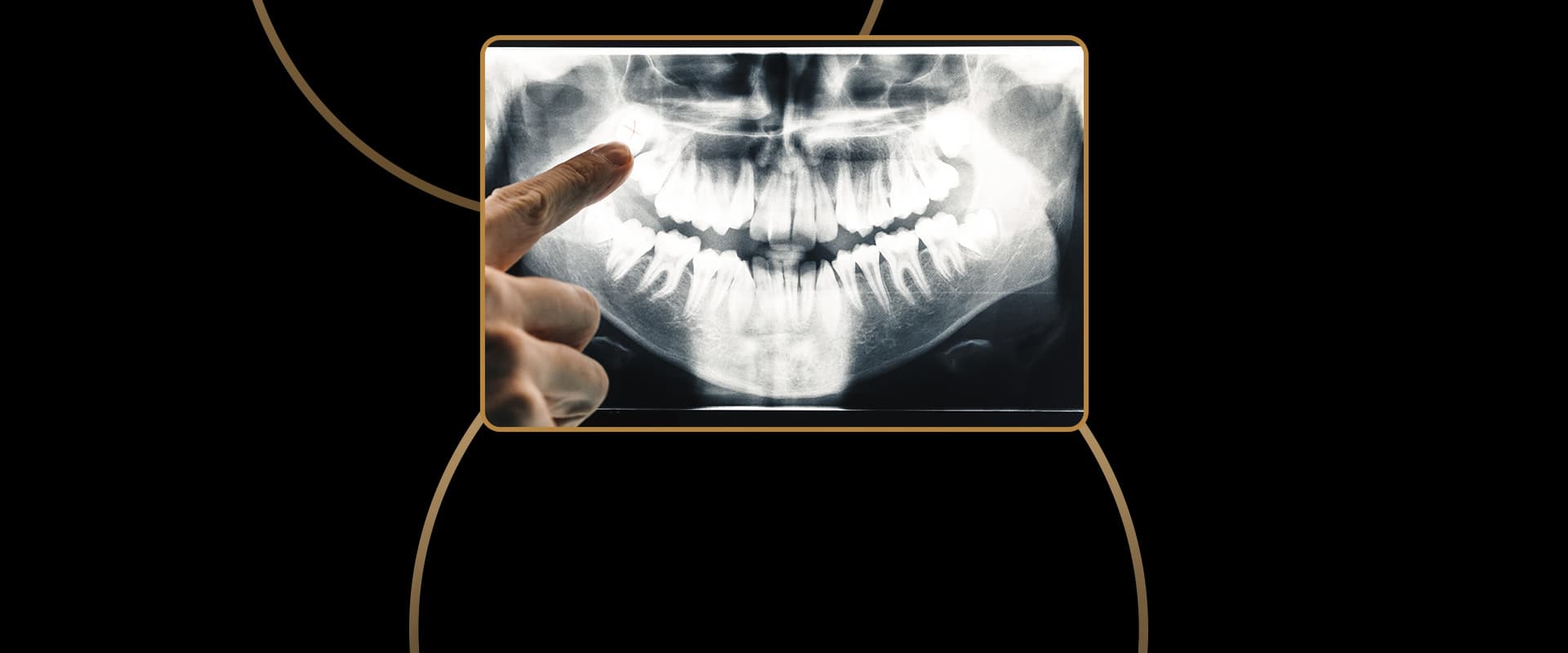 Panoramic X-Rays