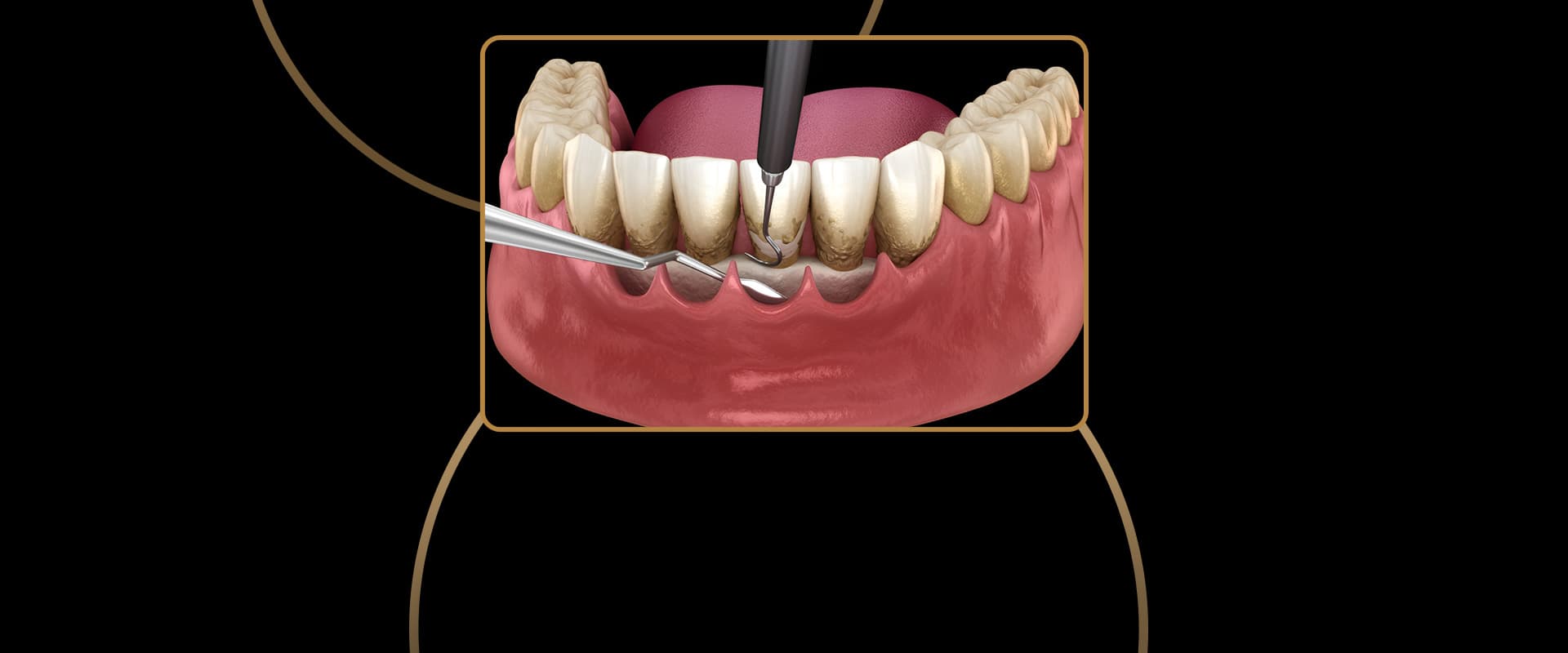 Periodontal Treatment