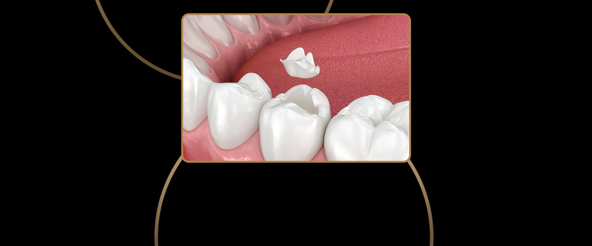 Porcelain Inlays
