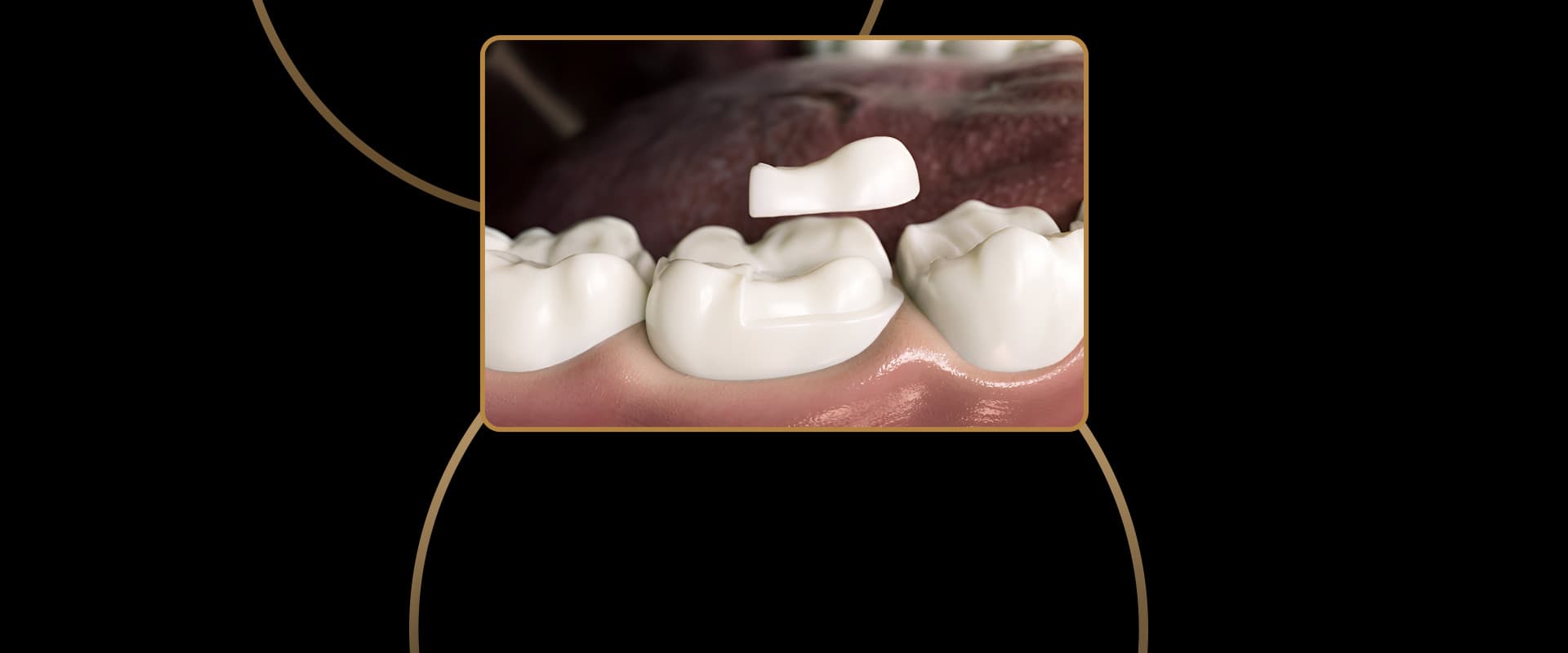 Porcelain Onlays