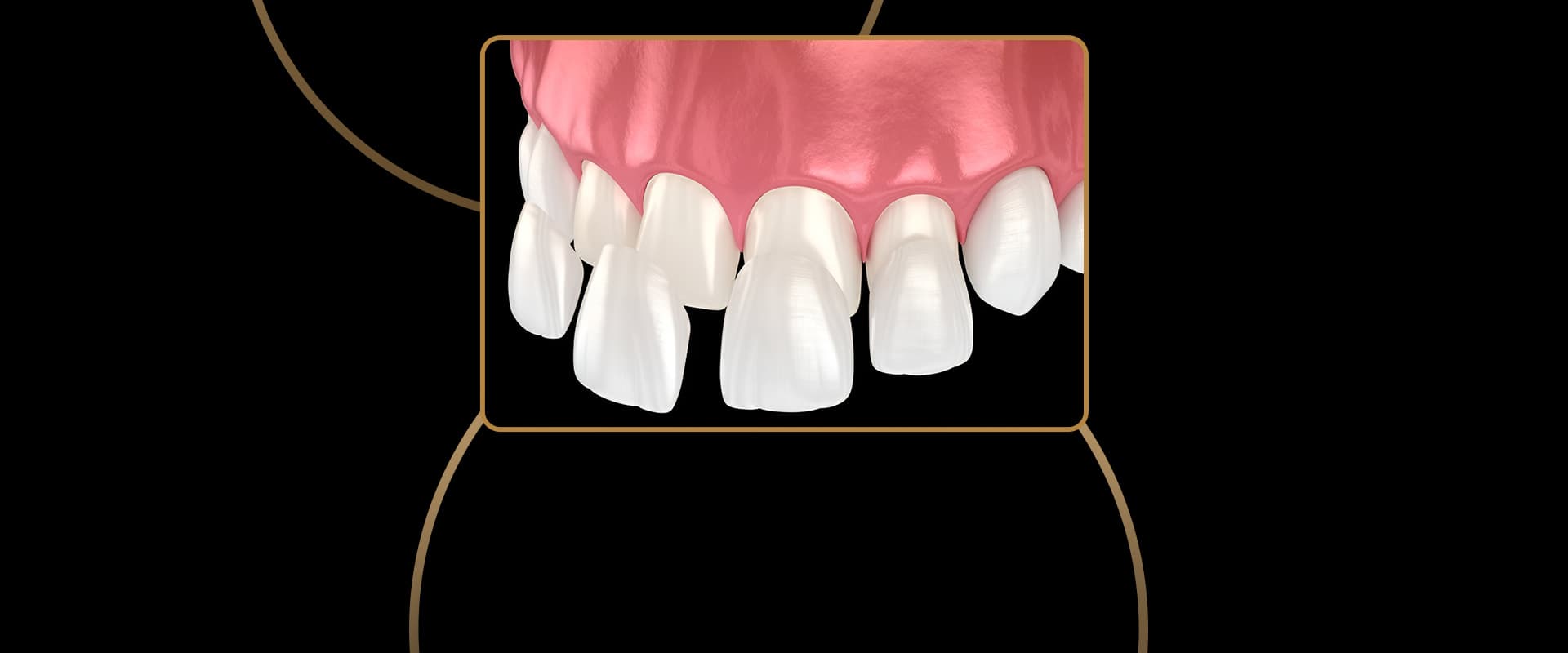 Porcelain Veneers