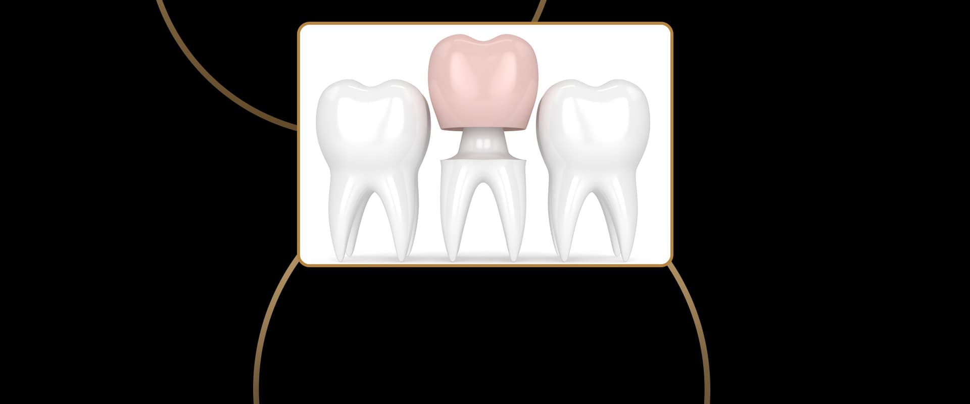 Procera Crowns
