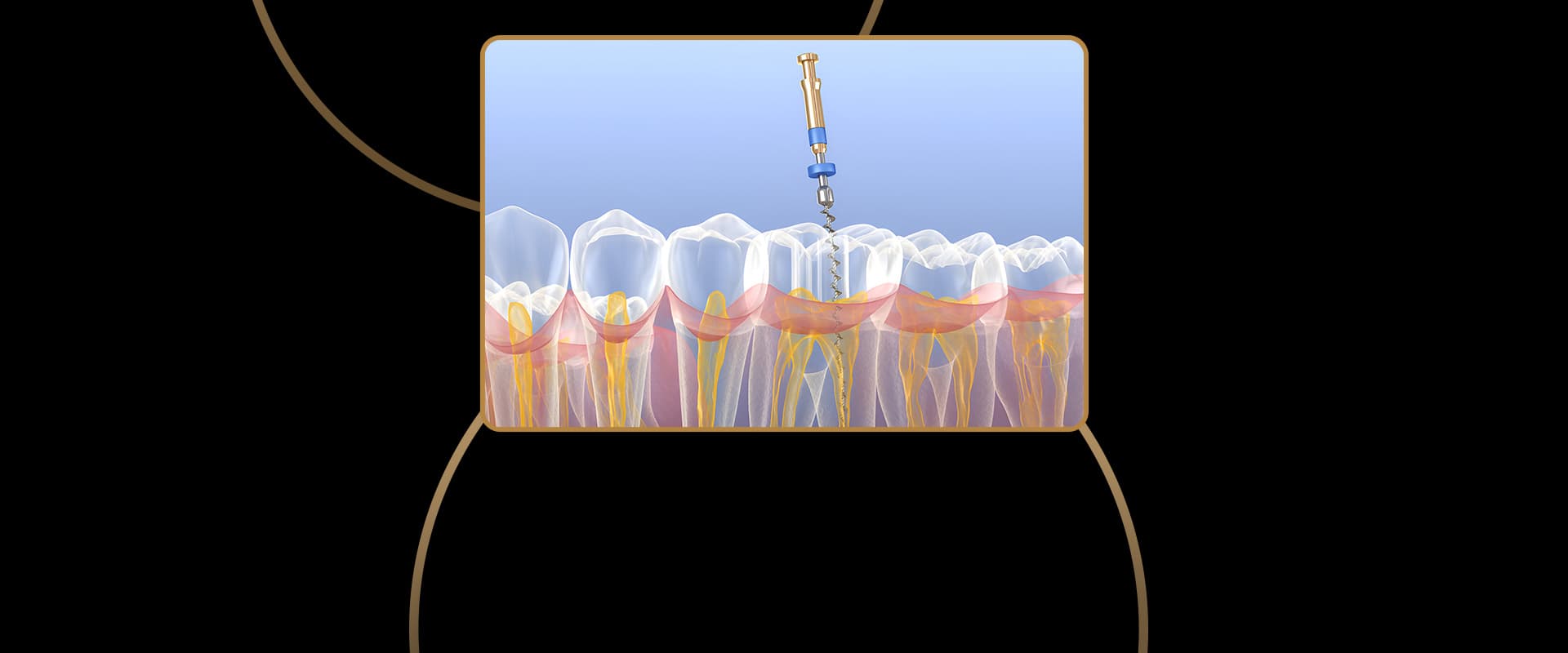 Root Canal Retreatment