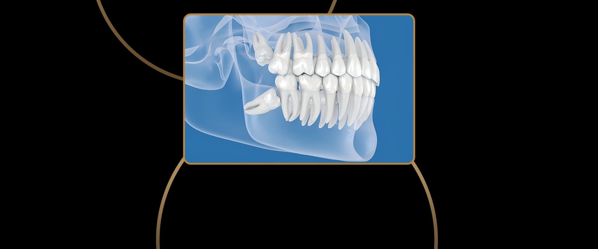 Wisdom Teeth Extractions