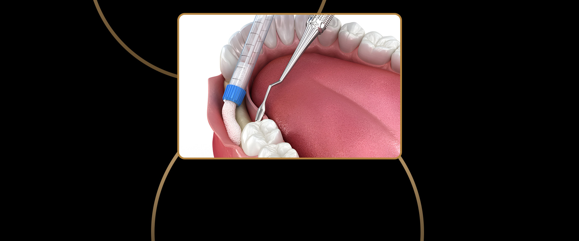 Bone Grafting