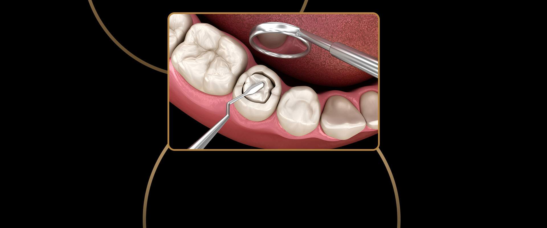 Composite Fillings