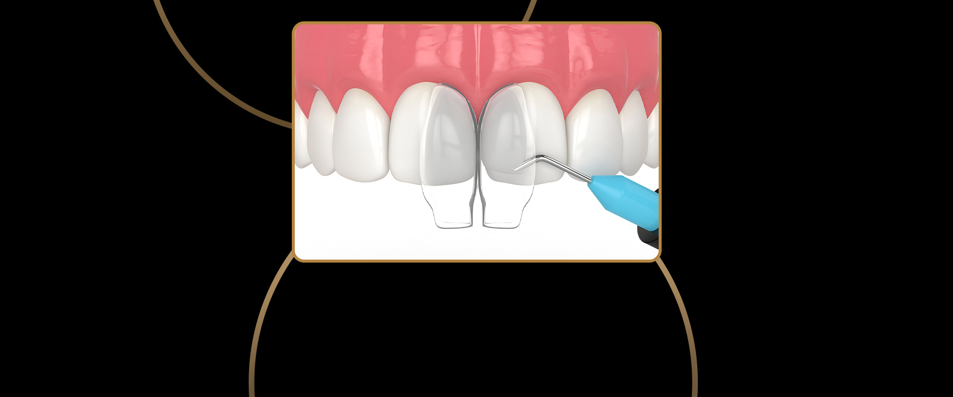 Dental Bonding