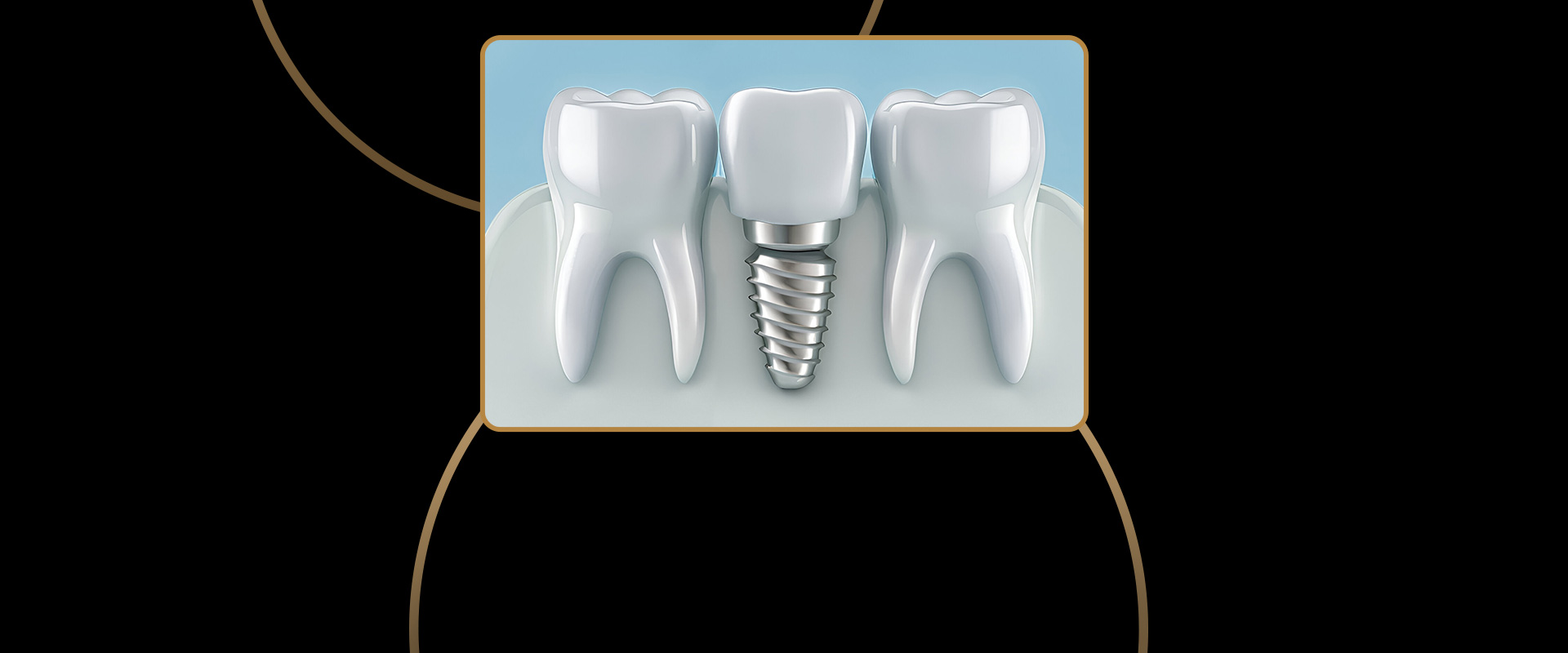 Dental Implants Cosmetic