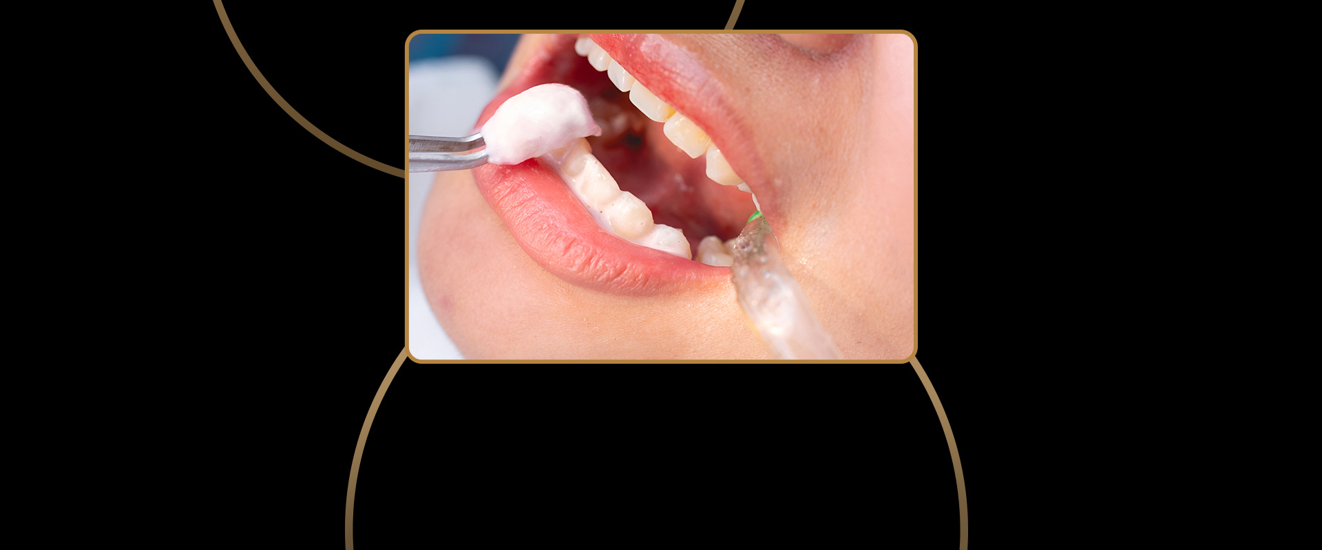 Fluoride Treatment