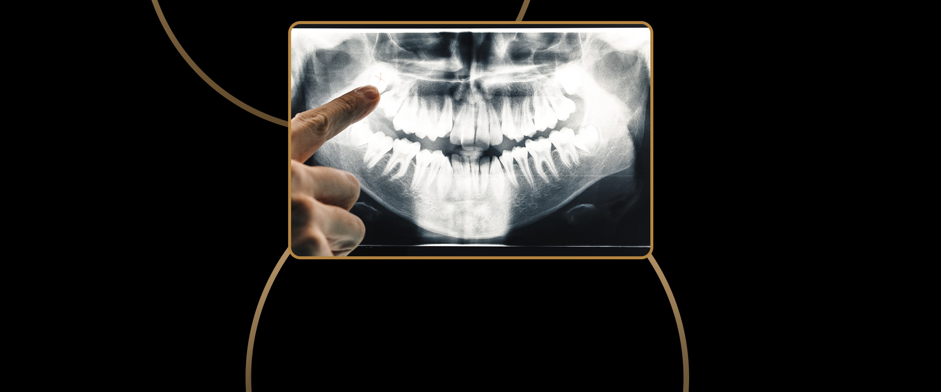 Panoramic X-Rays