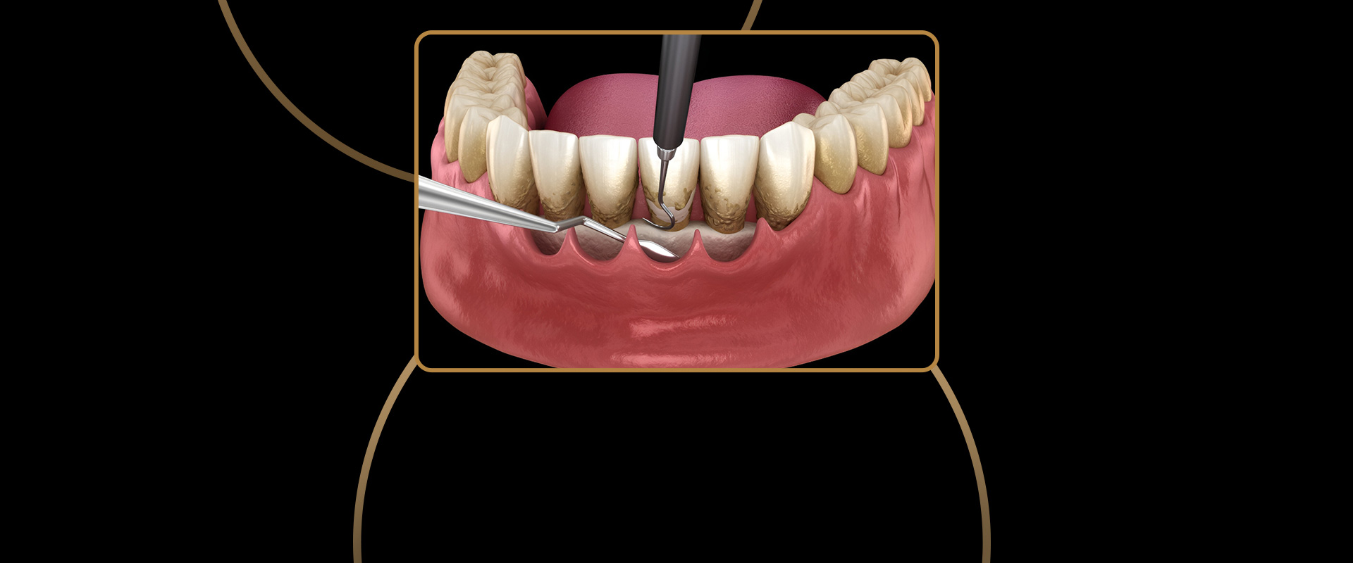 Periodontal Treatment