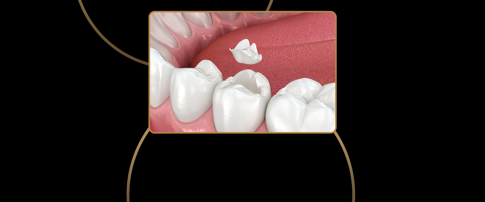 Porcelain Inlays