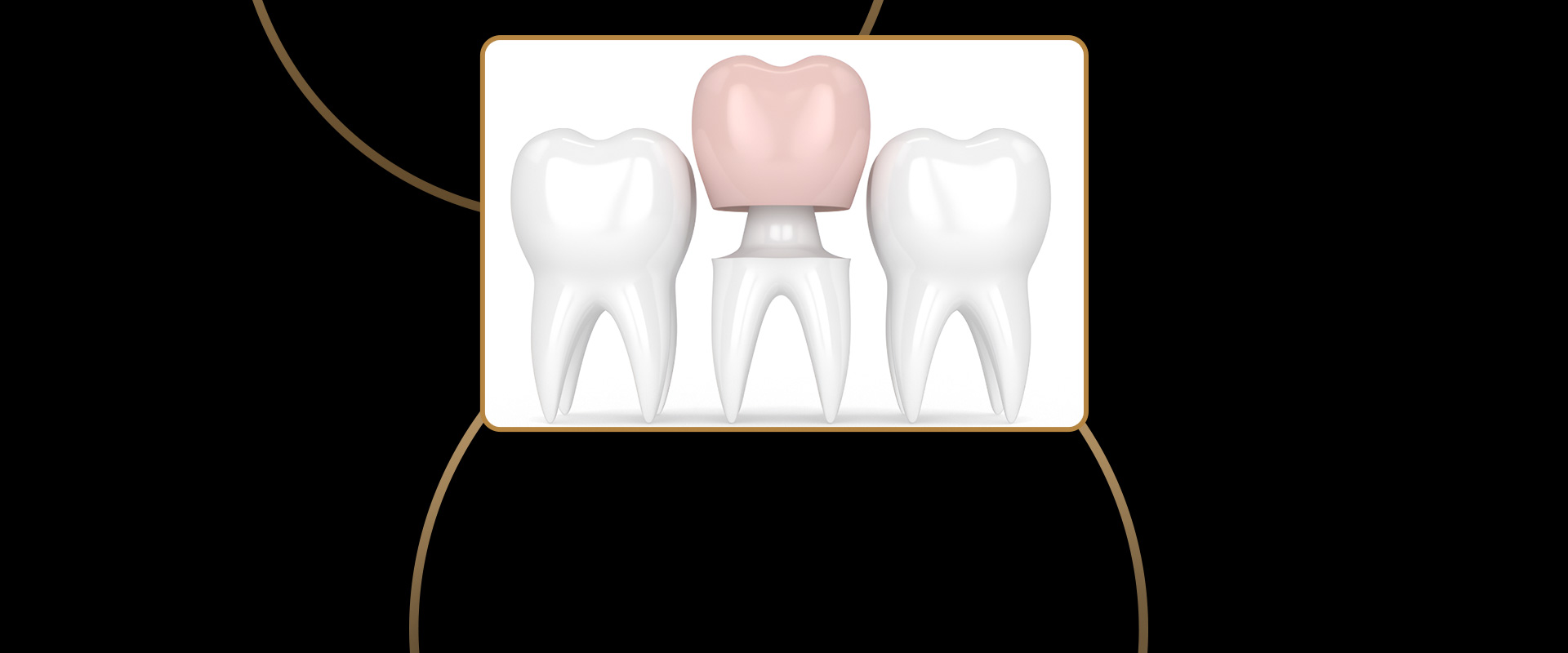 Procera Crowns