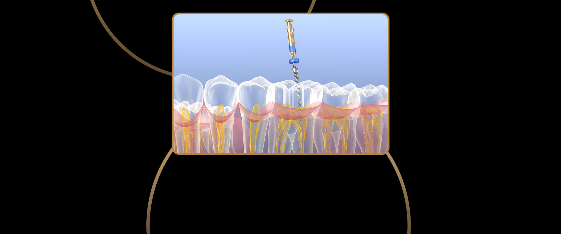 Root Canal Retreatment